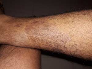 ayurvedic treatment for skin cancer