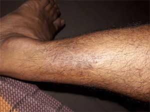 patient cure report for ayurvedic treatment for cancer of skin disease - mycosis fungoide
